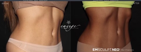 emsculpt neo abdomen before and after, emsculpt neo review, tulsa emsculpt neo, emily gemma