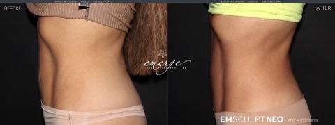 emsculpt neo abdomen before and after, emsculpt neo review, tulsa emsculpt neo, emily gemma