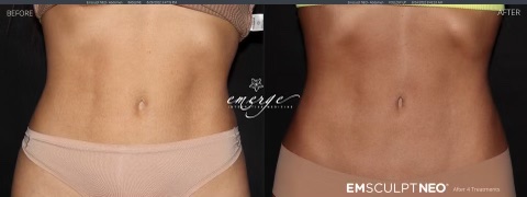 emsculpt neo abdomen before and after, emsculpt neo review, tulsa emsculpt neo, emily gemma